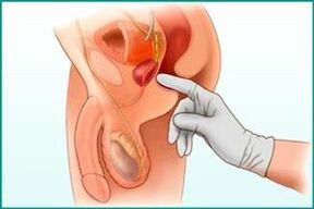 Palpation de la prostate